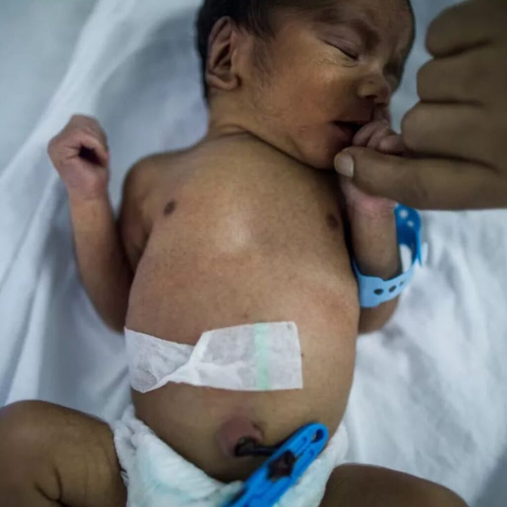 NICU में शॉर्ट सर्किट से आग लगी, नवजात की मौत:शरीर काला पड़ा, खाल झुलसी; घरवालों ने अस्पताल में हंगामा किया