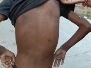 कानपुर में चाची ने भतीजी को हीटर से जलायाः भाई ने पुलिस को फोन किया, बोला- जल्दी आ जाकर बहन को बचा लीजिए